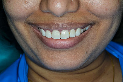 Smile Analysis and Designing 1 smile designing