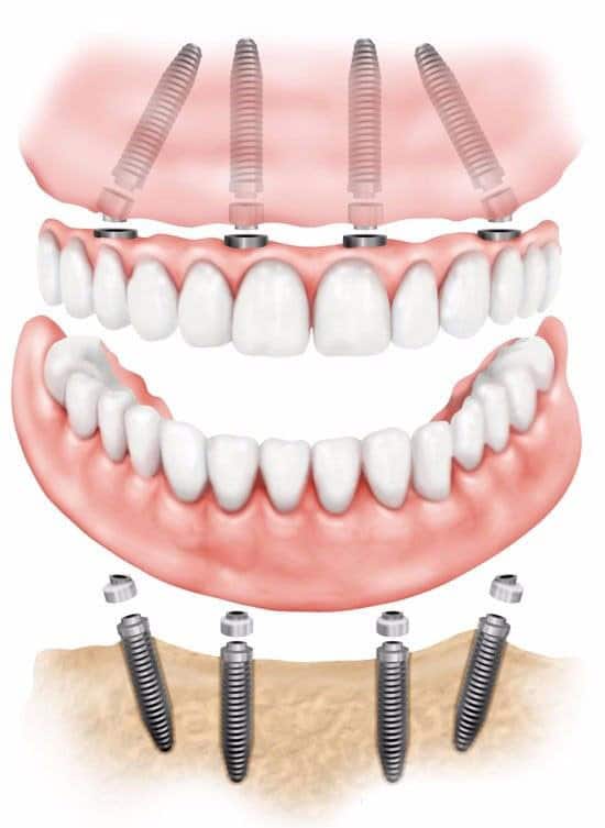 dental implants in mumbai