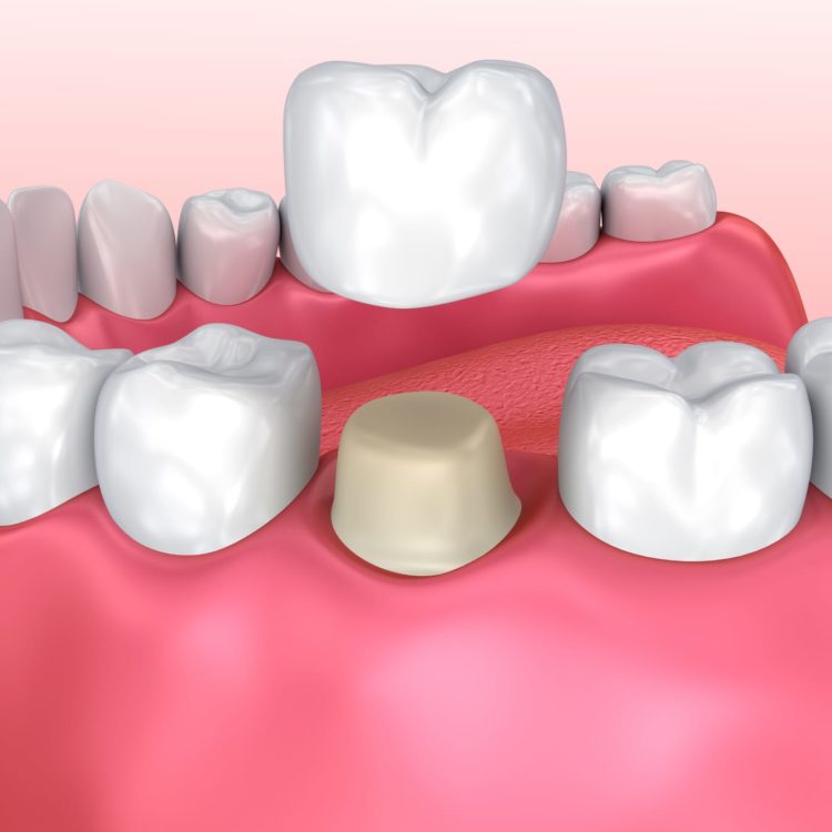 dental crown and bridge 