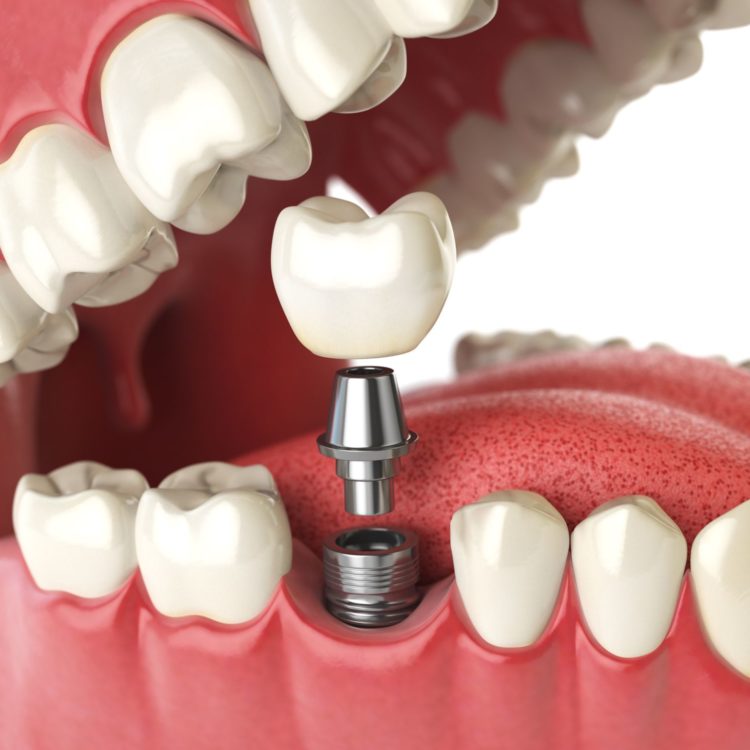 dental implants in mumbai