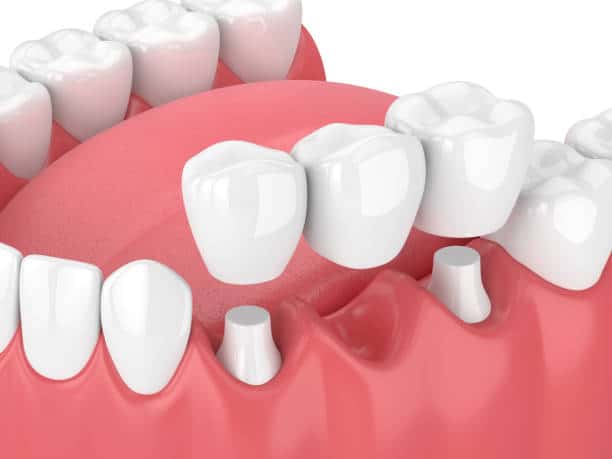 dental crown and bridge 