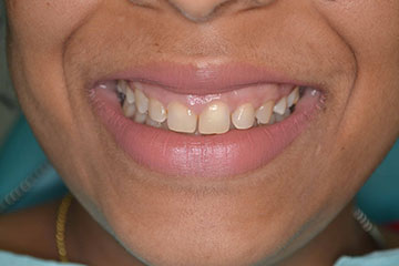 best teeth whitening treatment