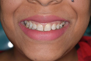 best teeth whitening treatment