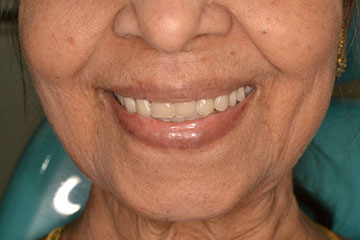 Vista Dental Care Patient 2 denture after