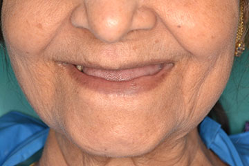 Vista Dental Care Patient 2 denture before