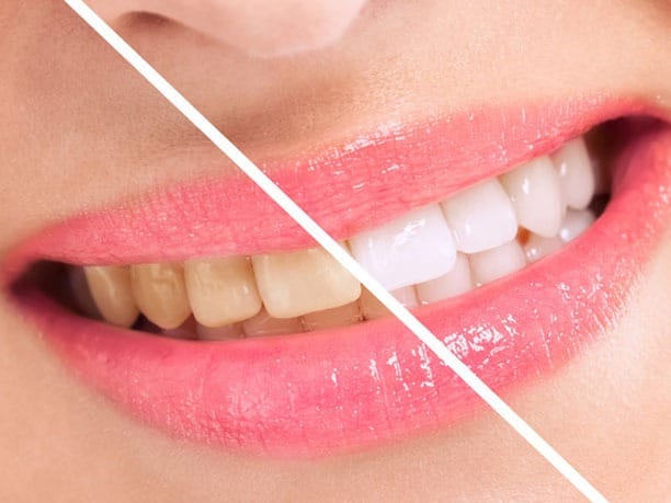 Best Teeth Whitening Treatment in Mumbai