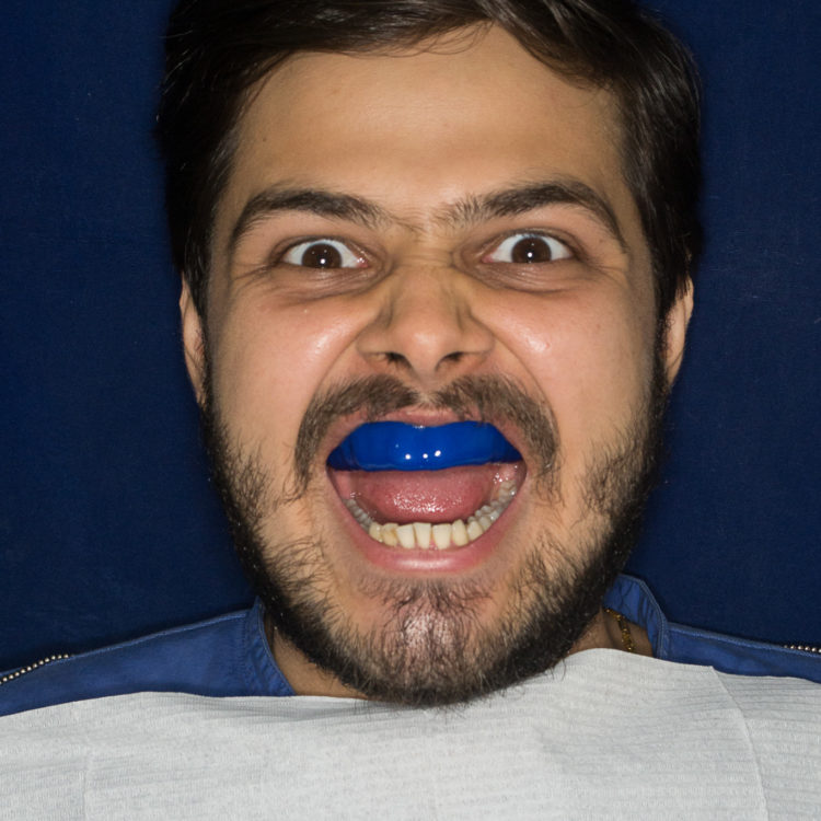 Dental Mouth Guards