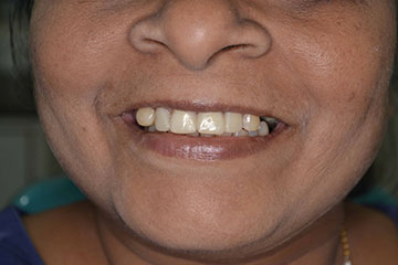Vista Dental Care Patient Contouring