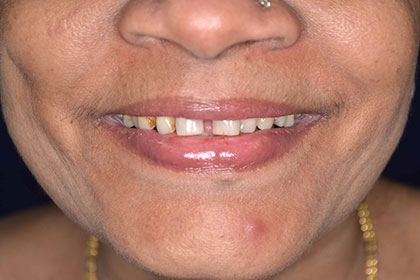 tooth contouring & reshaping treatment