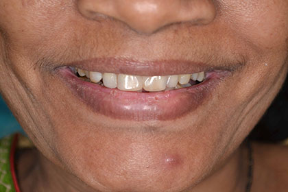tooth contouring & reshaping